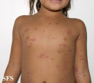 varicella