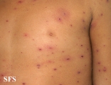 varicella