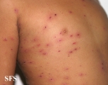 varicella