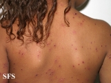 varicella