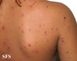varicella