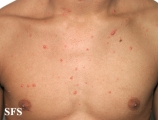 varicella
