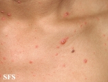 varicella