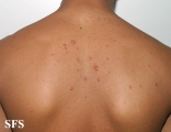 varicella