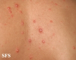 varicella