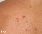varicella