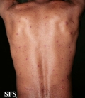 varicella
