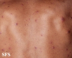 varicella
