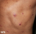 varicella