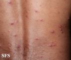 varicella