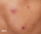 varicella