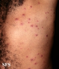 varicella