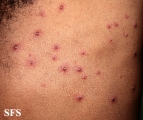 varicella