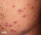 varicella