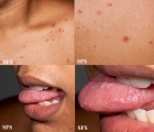 varicella