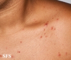 varicella
