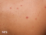 varicella