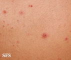 varicella