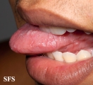 varicella