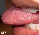 varicella