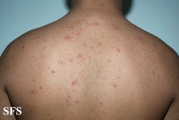 varicella