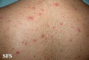 varicella