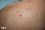 varicella