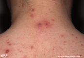 varicella