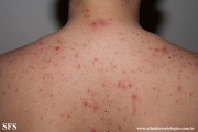 varicella