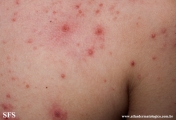 varicella