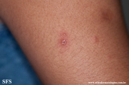 varicella