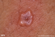 varicella