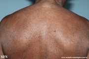 mycosis fungoides