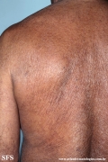 mycosis fungoides