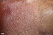 mycosis fungoides