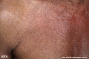mycosis fungoides