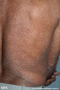 mycosis fungoides