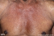mycosis fungoides