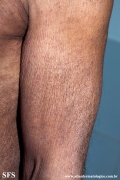 mycosis fungoides