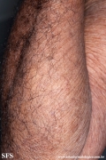 mycosis fungoides