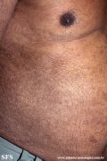 mycosis fungoides