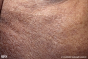 mycosis fungoides