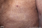 mycosis fungoides