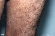 mycosis fungoides