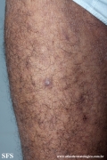 mycosis fungoides