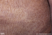 mycosis fungoides