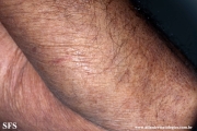 mycosis fungoides