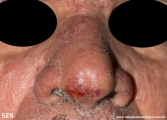 mycosis fungoides