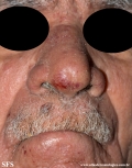 mycosis fungoides