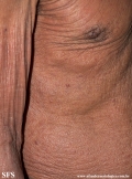 mycosis fungoides